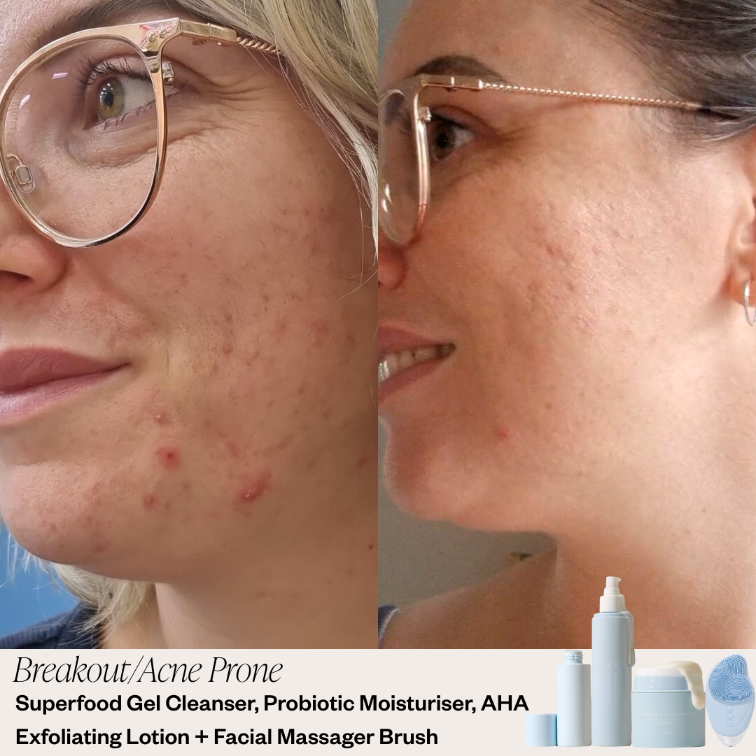 Beginner Skincare System - Breakout/Acne Prone